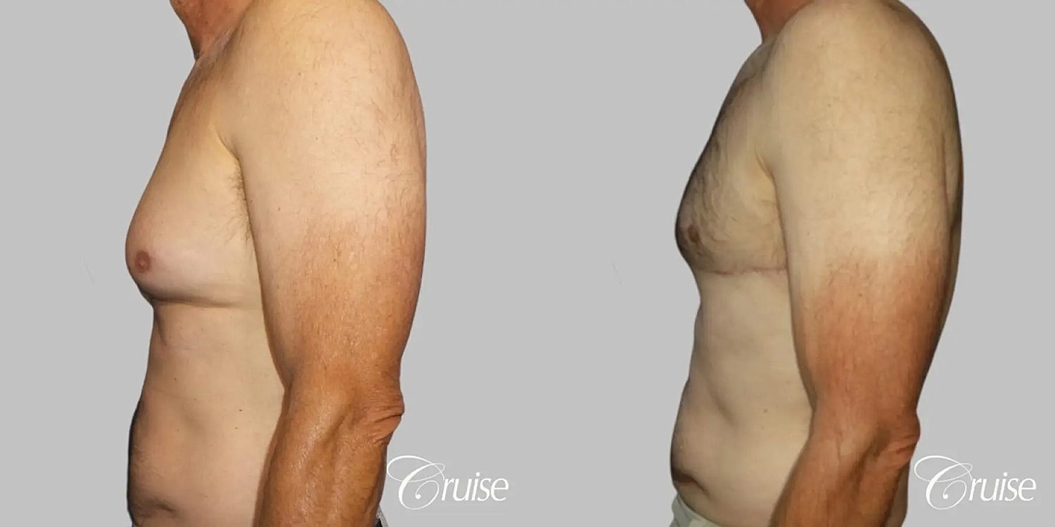 Gynecomastia Before & After