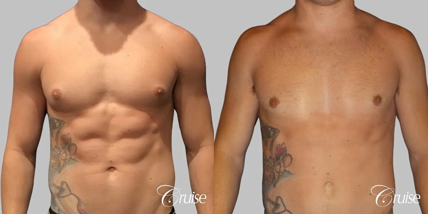 Gynecomastia Before & After