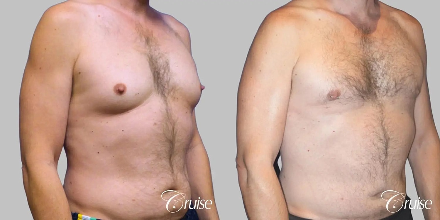 Gynecomastia Before & After