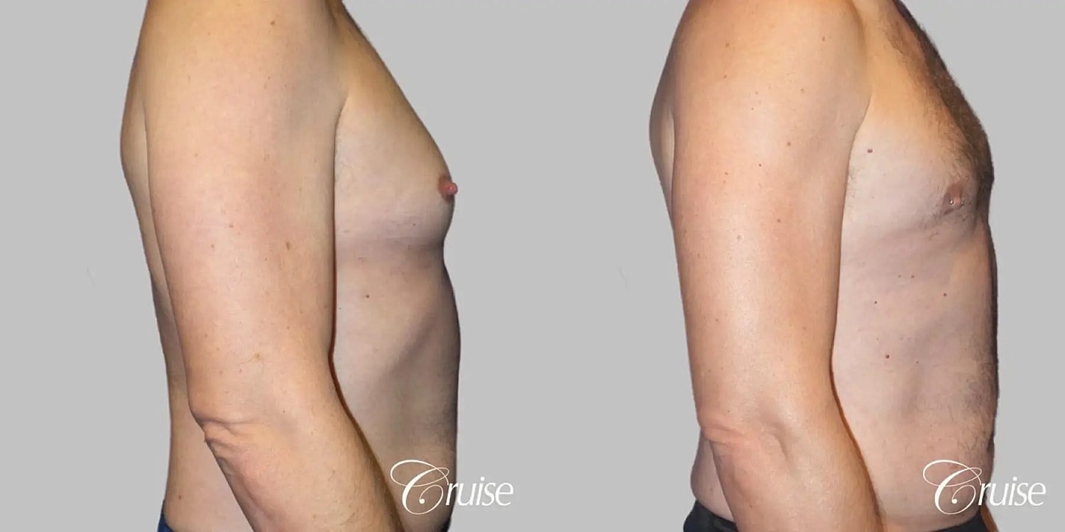 Gynecomastia Before & After