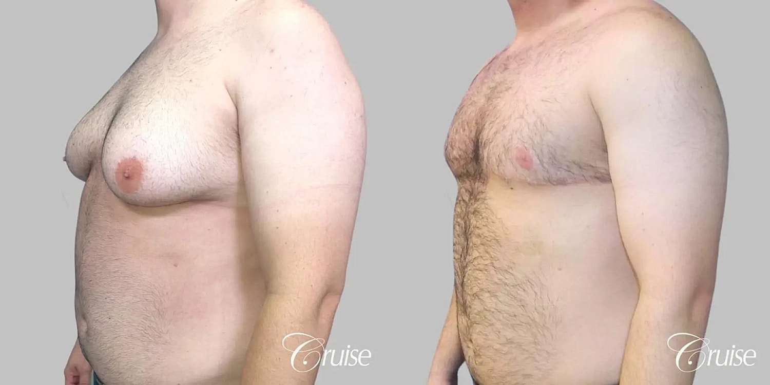 Gynecomastia Before & After