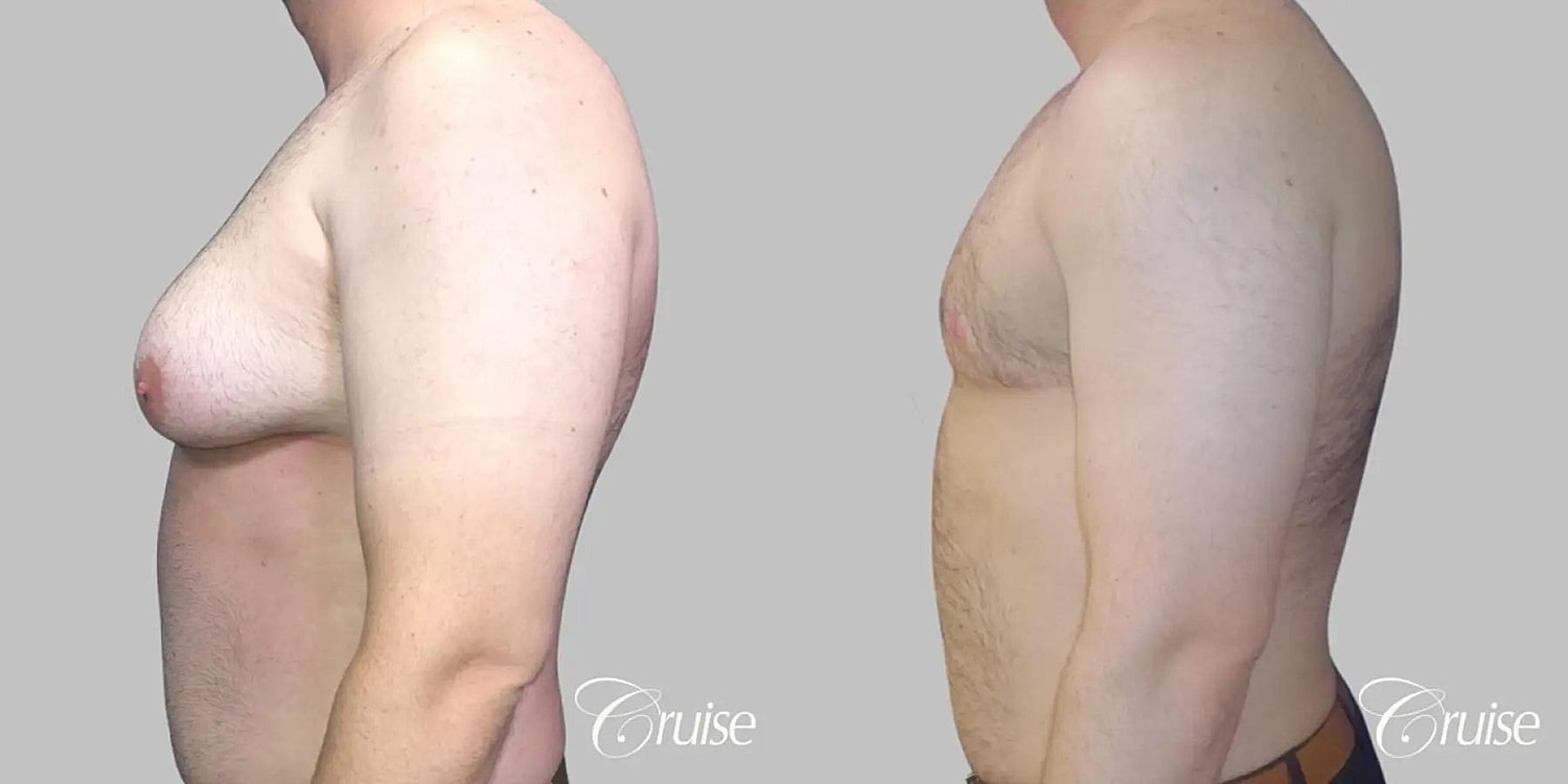 Gynecomastia Before & After