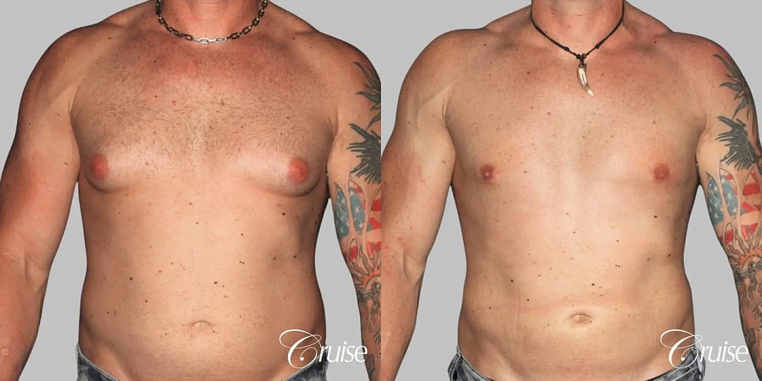 Gynecomastia Before & After
