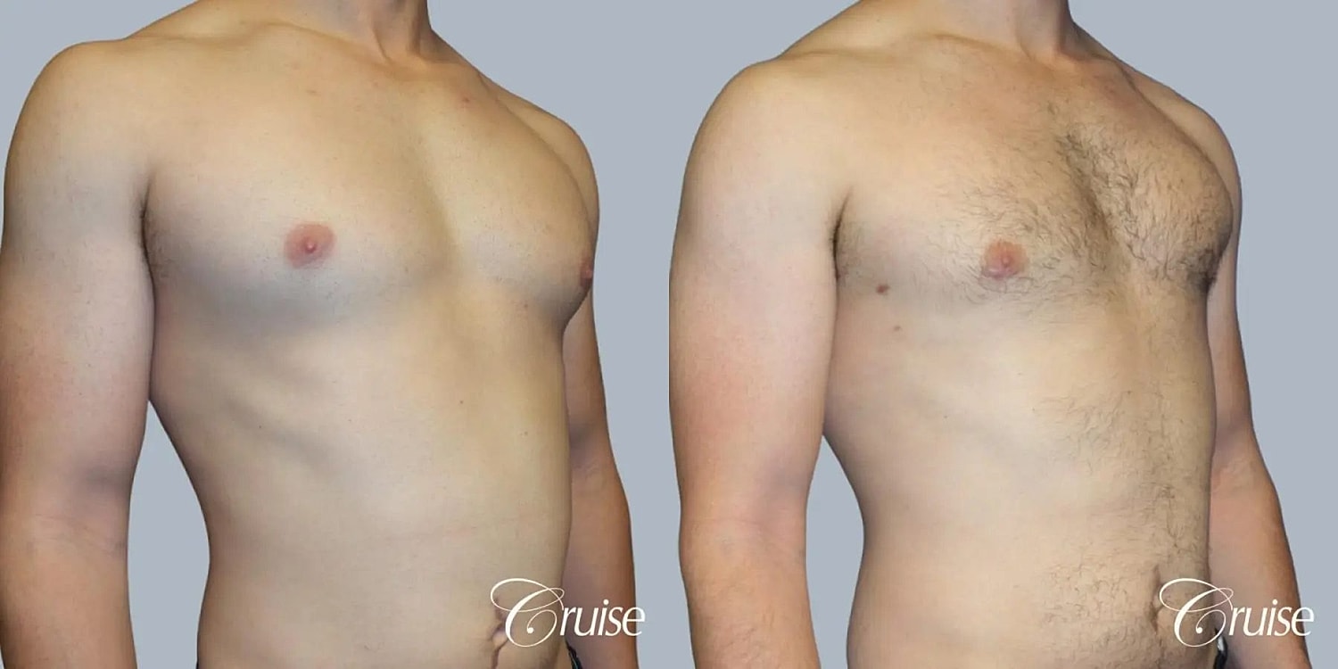 Gynecomastia Before & After