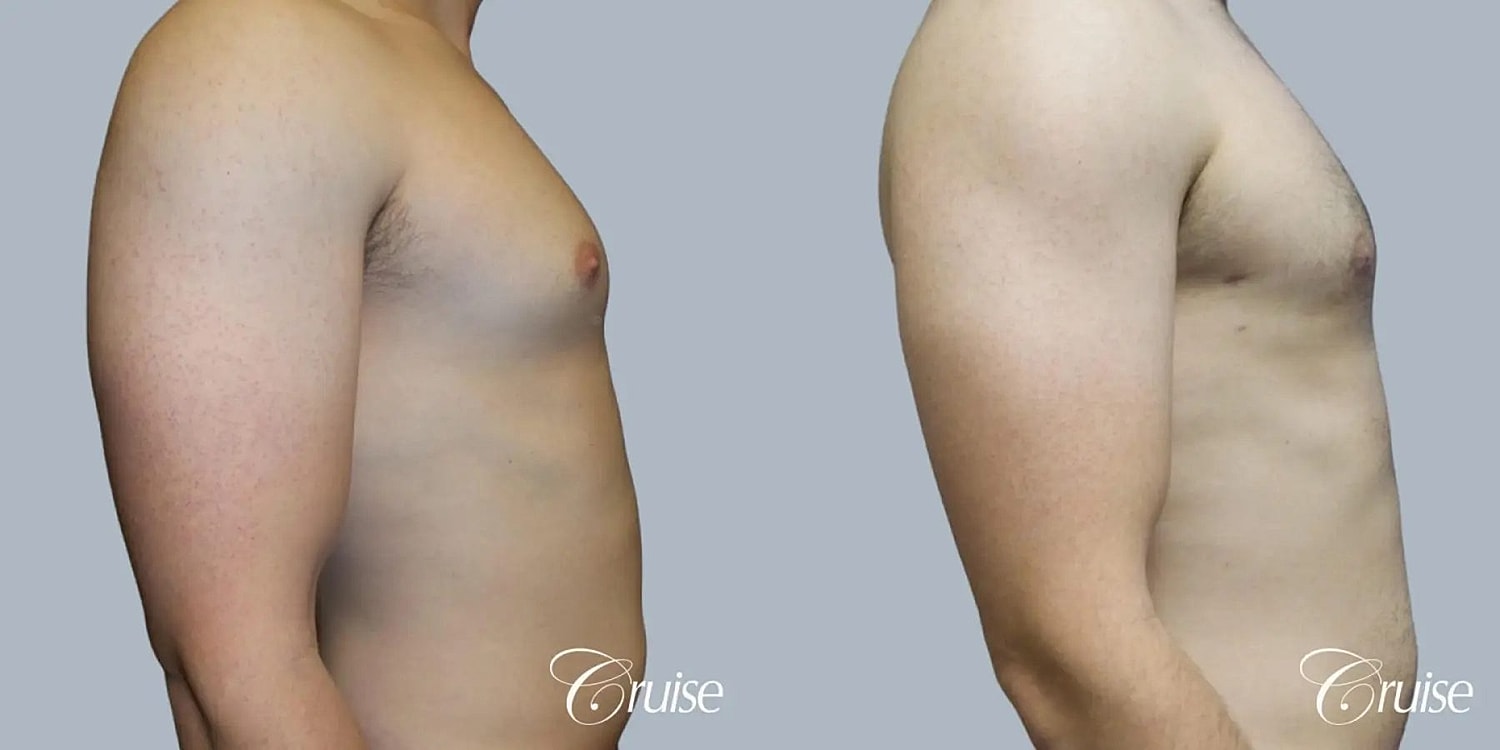 Gynecomastia Before & After