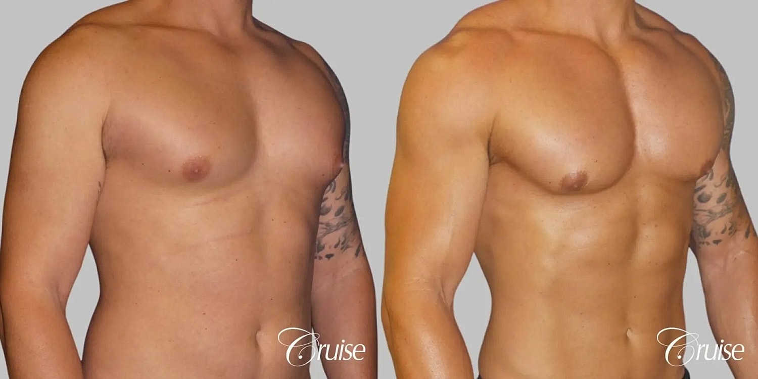 Gynecomastia Before & After