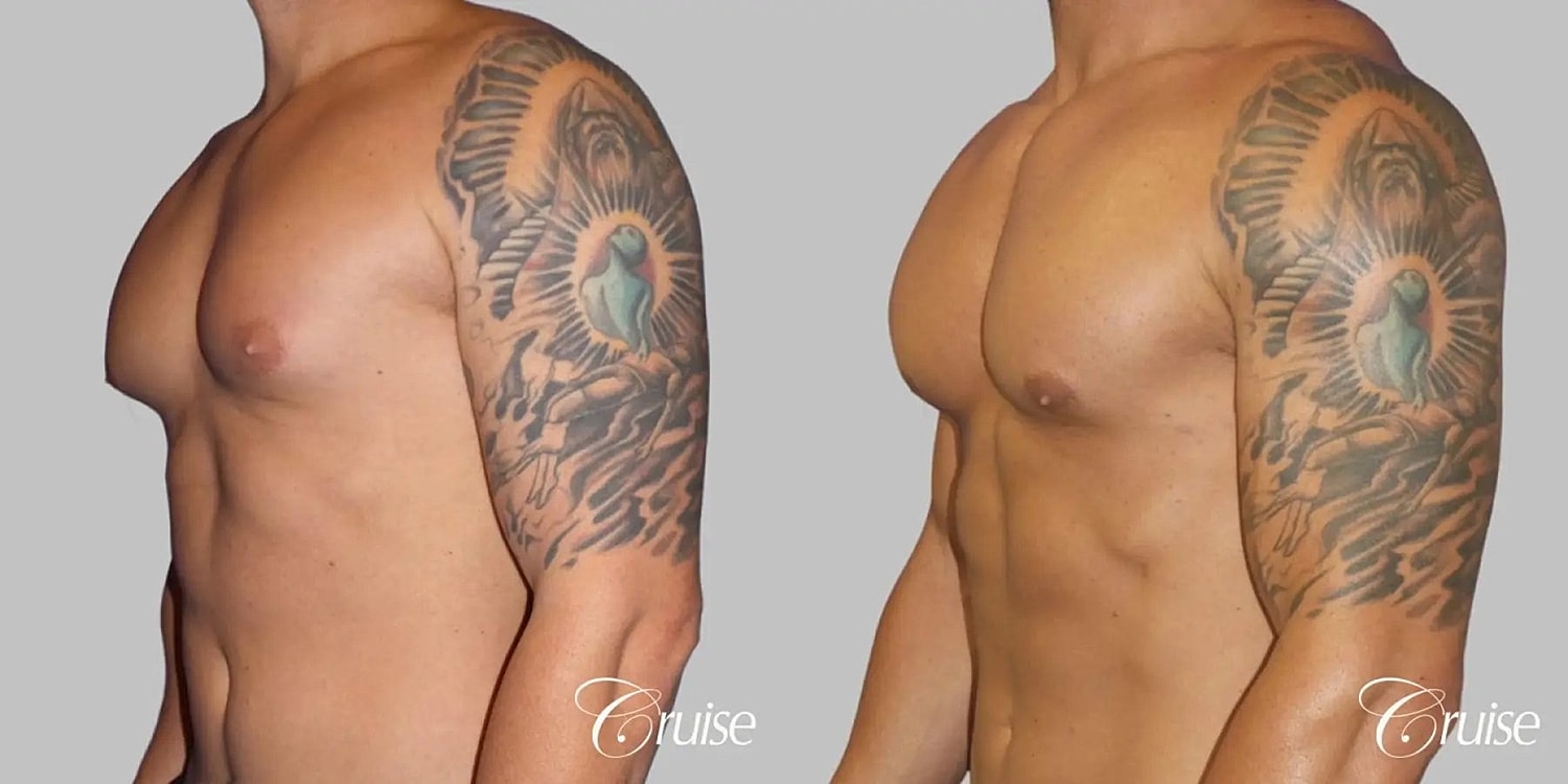 Gynecomastia Before & After