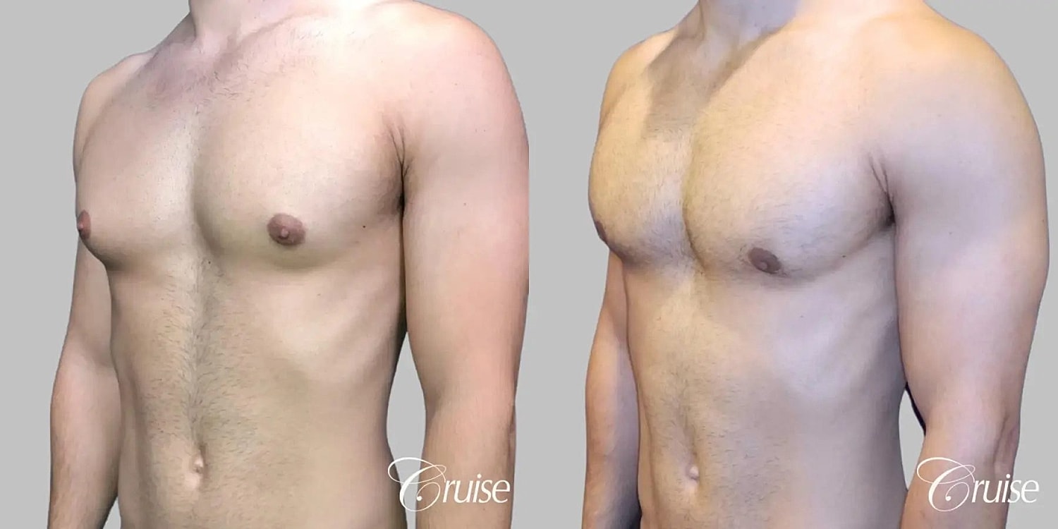 Gynecomastia Before & After