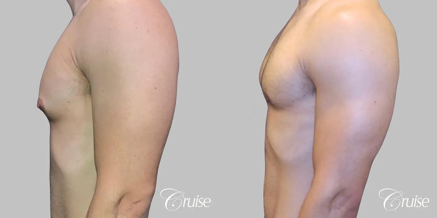 Gynecomastia Before & After