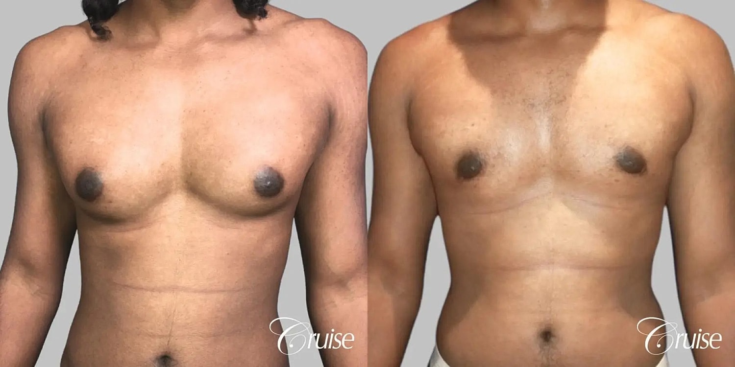 Gynecomastia Before & After