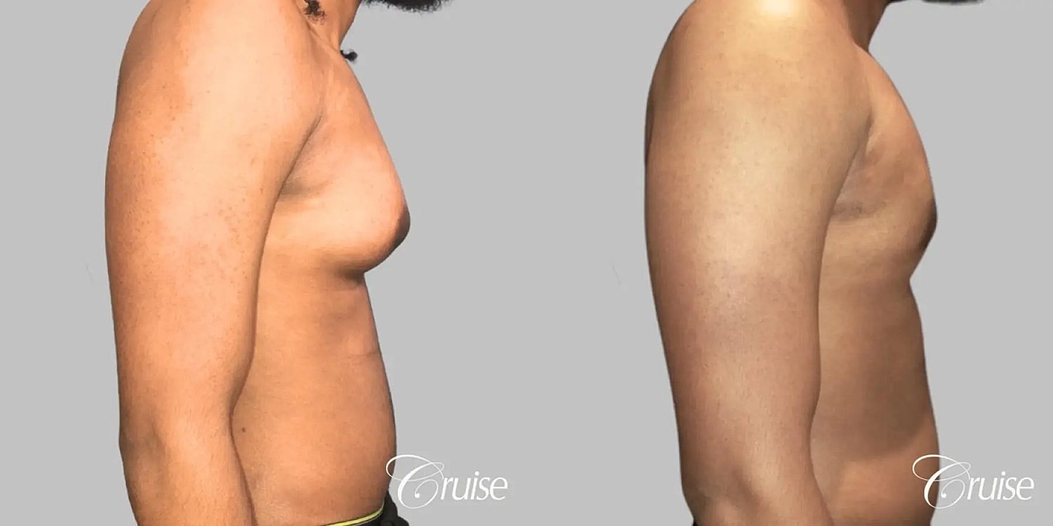 Gynecomastia Before & After