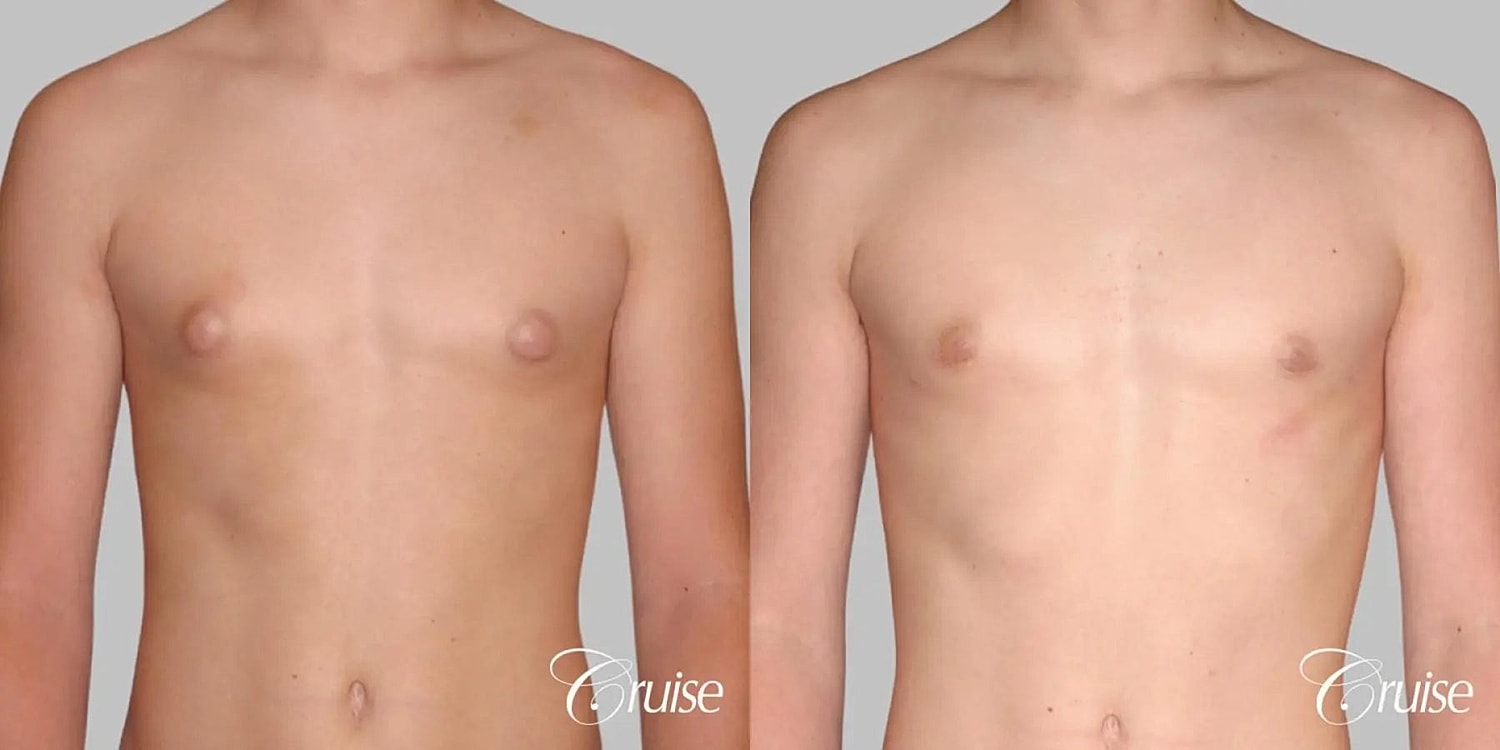 Gynecomastia Before & After