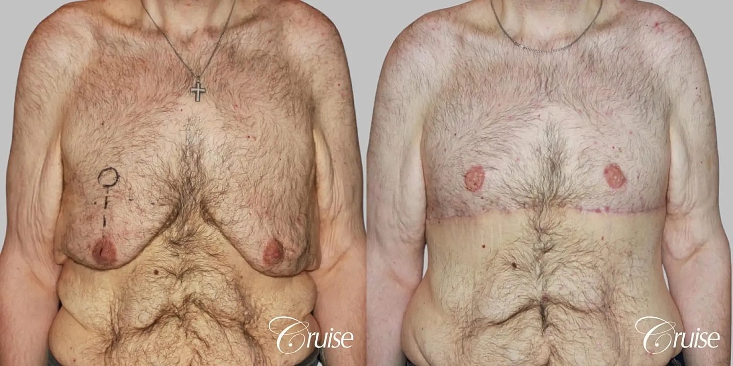 Gynecomastia Before & After