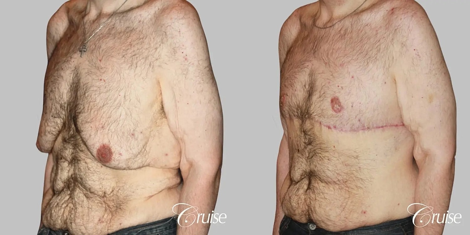 Gynecomastia Before & After
