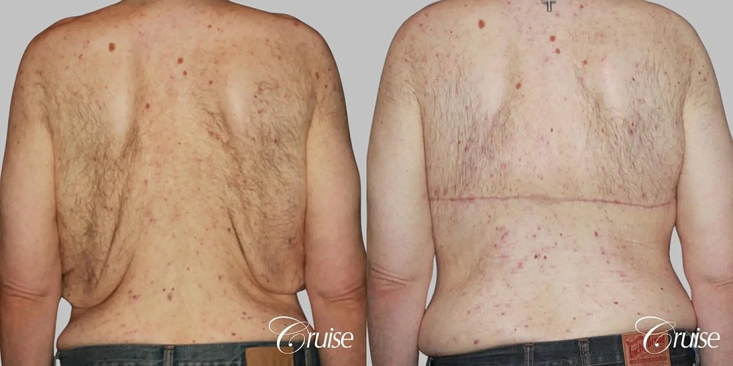 Gynecomastia Before & After