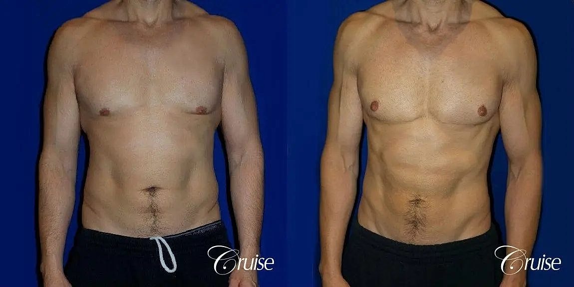 Gynecomastia Before & After
