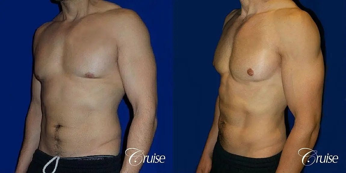 Gynecomastia Before & After