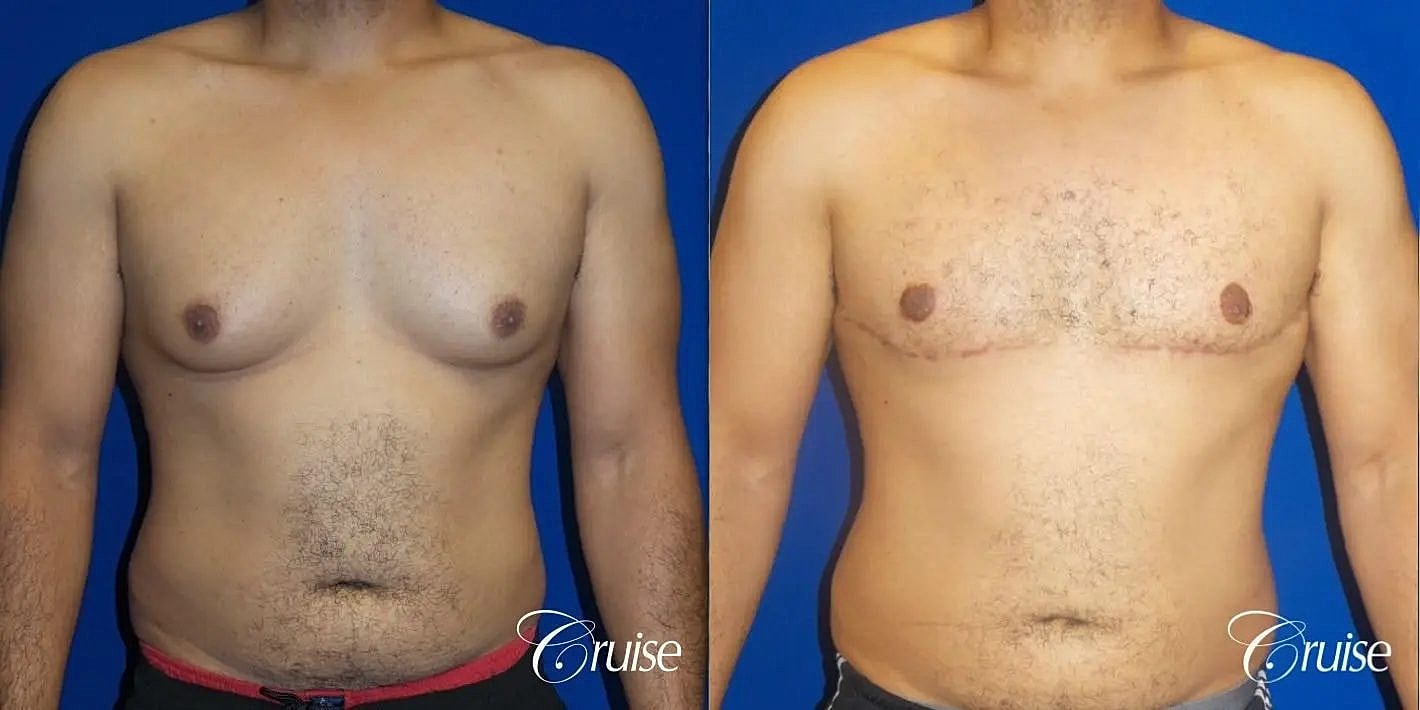 Gynecomastia Before & After