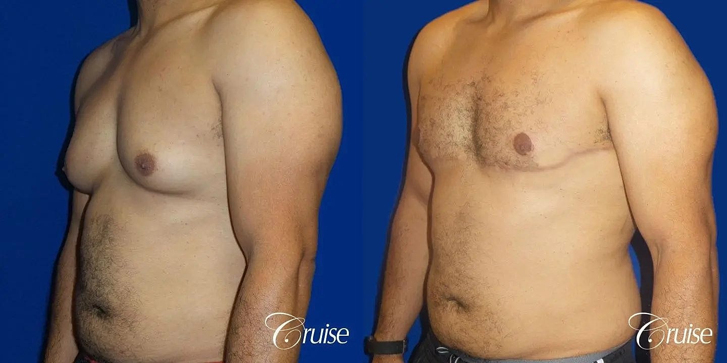 Gynecomastia Before & After
