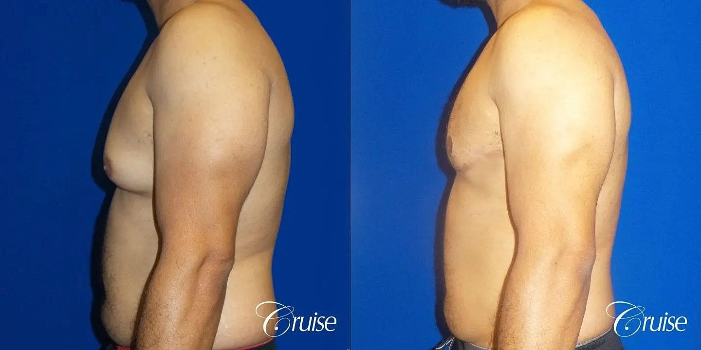 Gynecomastia Before & After