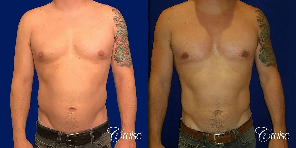Gynecomastia Before & After