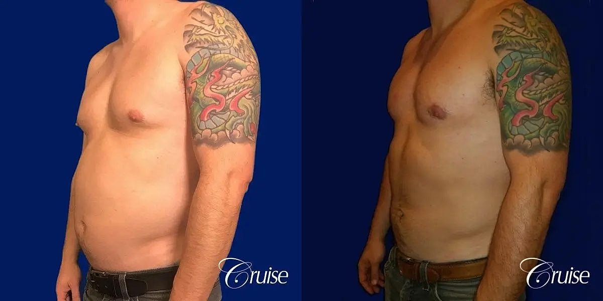 Gynecomastia Before & After