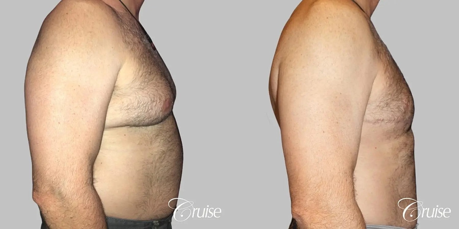 Gynecomastia Before & After
