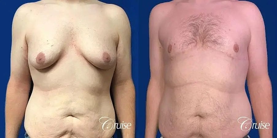 Gynecomastia Before & After