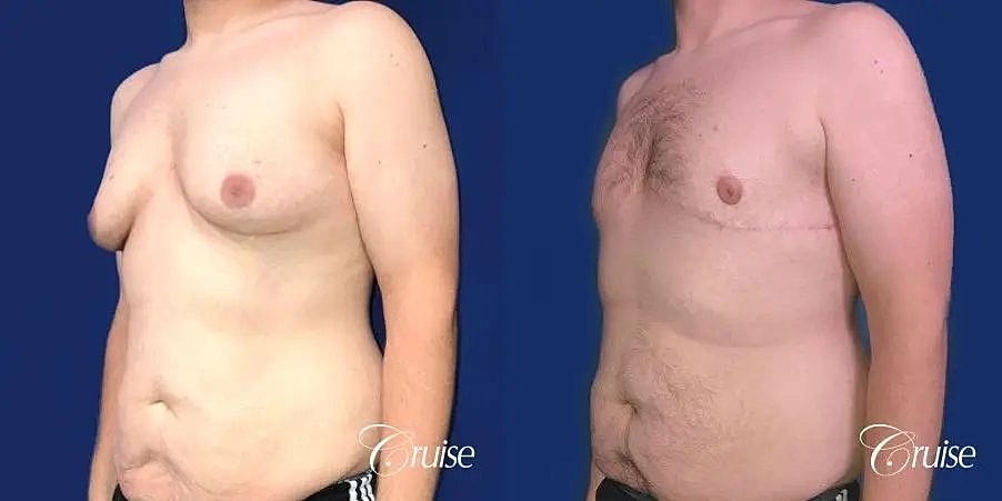 Gynecomastia Before & After