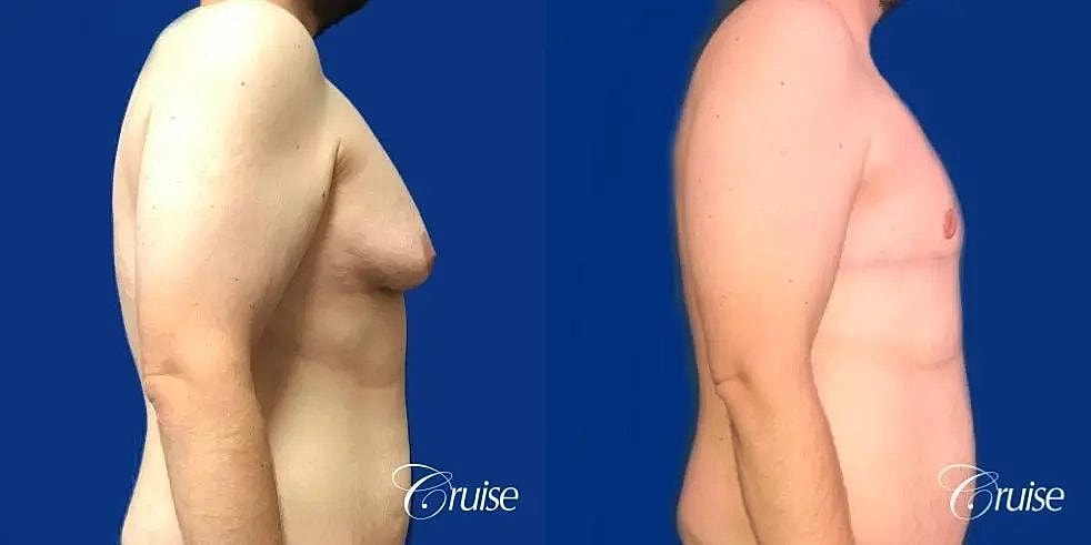 Gynecomastia Before & After