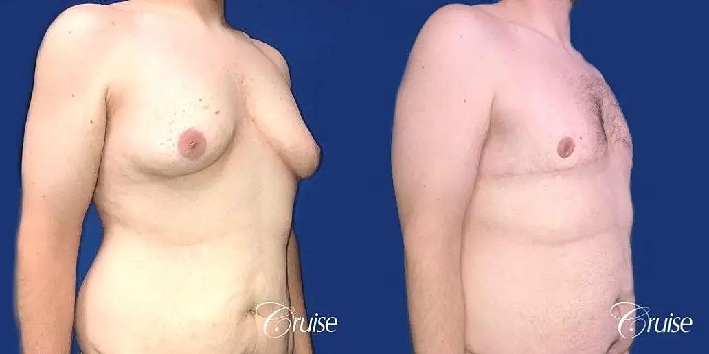 Gynecomastia Before & After