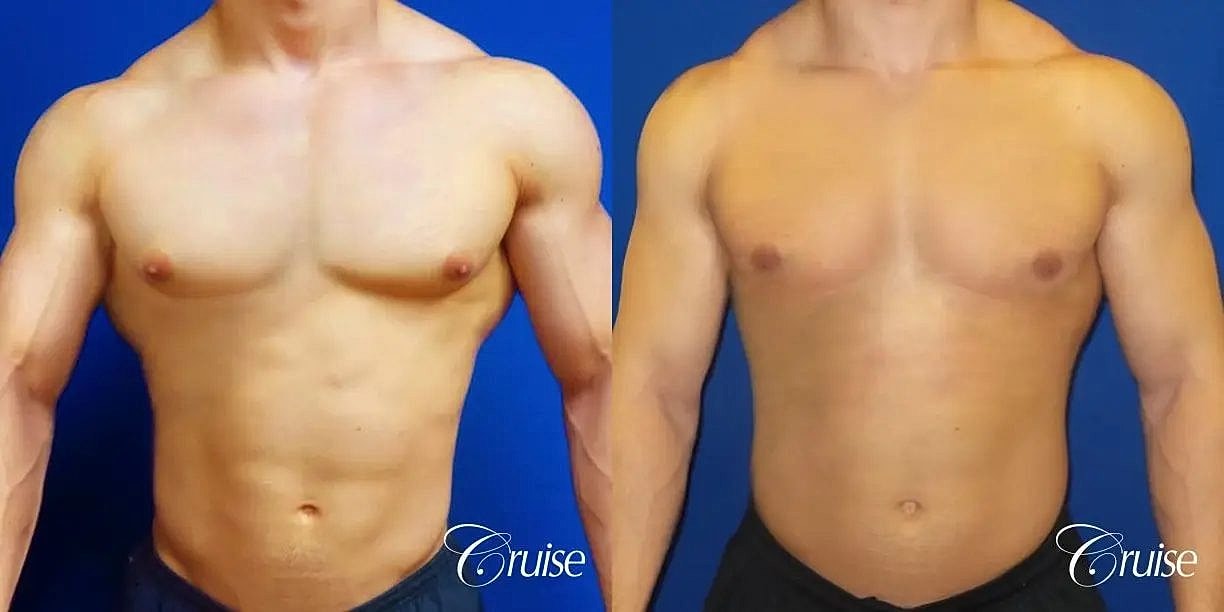 Gynecomastia Before & After