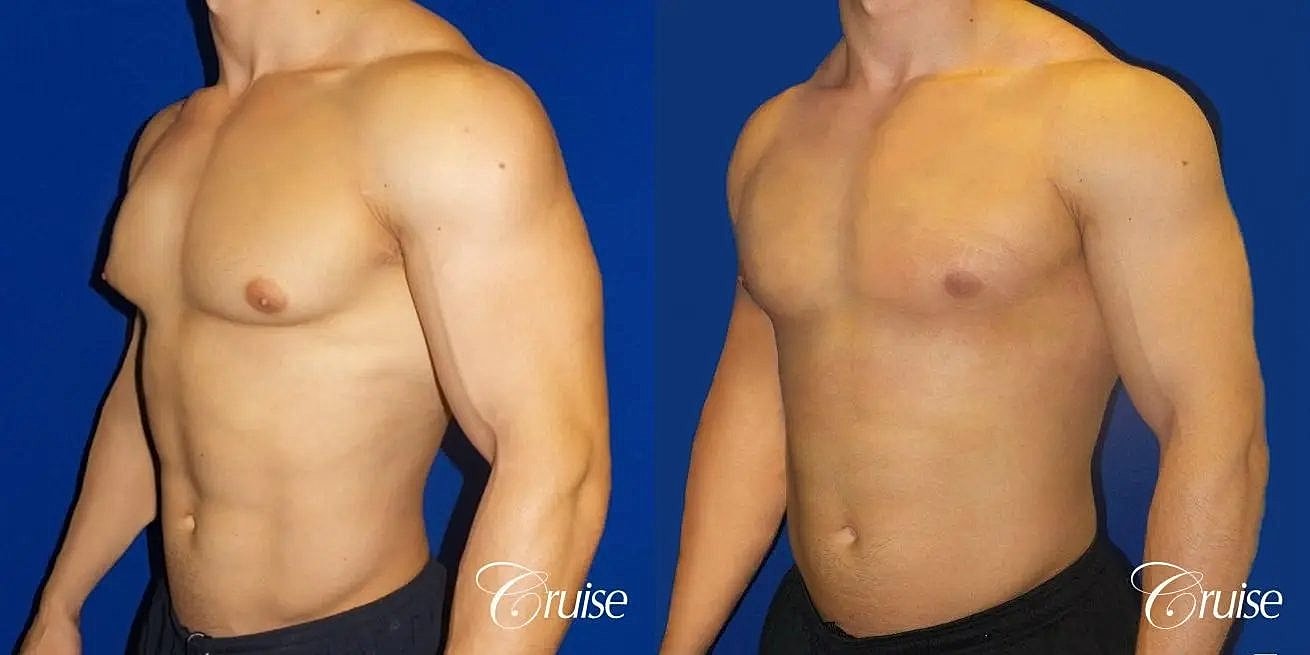 Gynecomastia Before & After