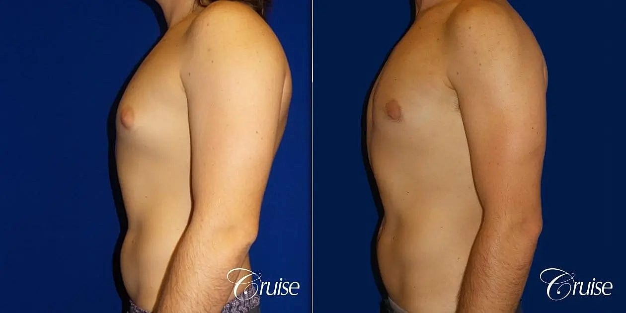 Gynecomastia Before & After