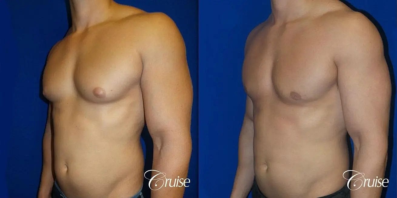 Gynecomastia Before & After