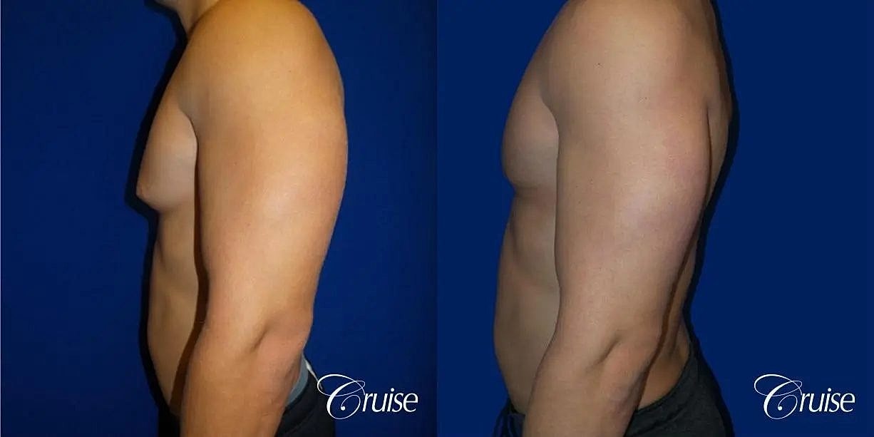 Gynecomastia Before & After