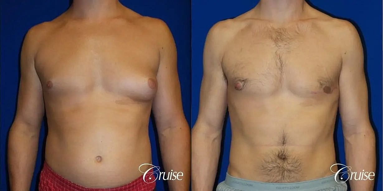Gynecomastia Before & After