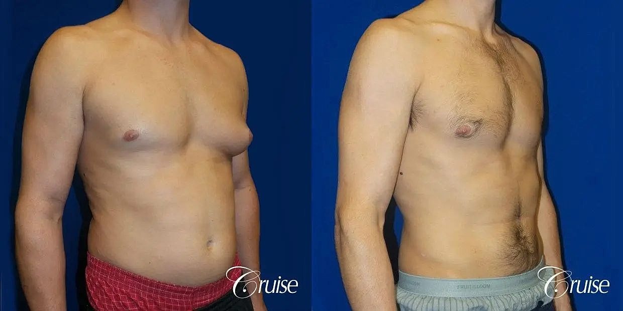 Gynecomastia Before & After