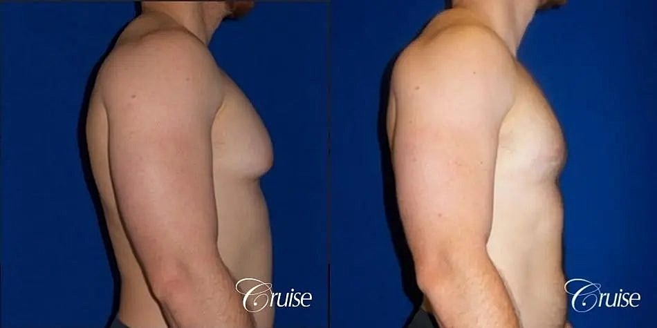 Gynecomastia Before & After
