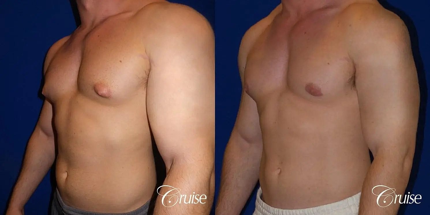 Gynecomastia Before & After