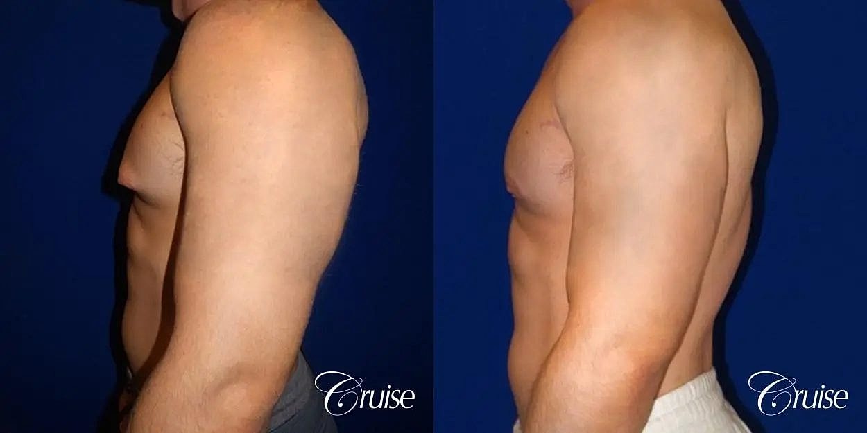 Gynecomastia Before & After