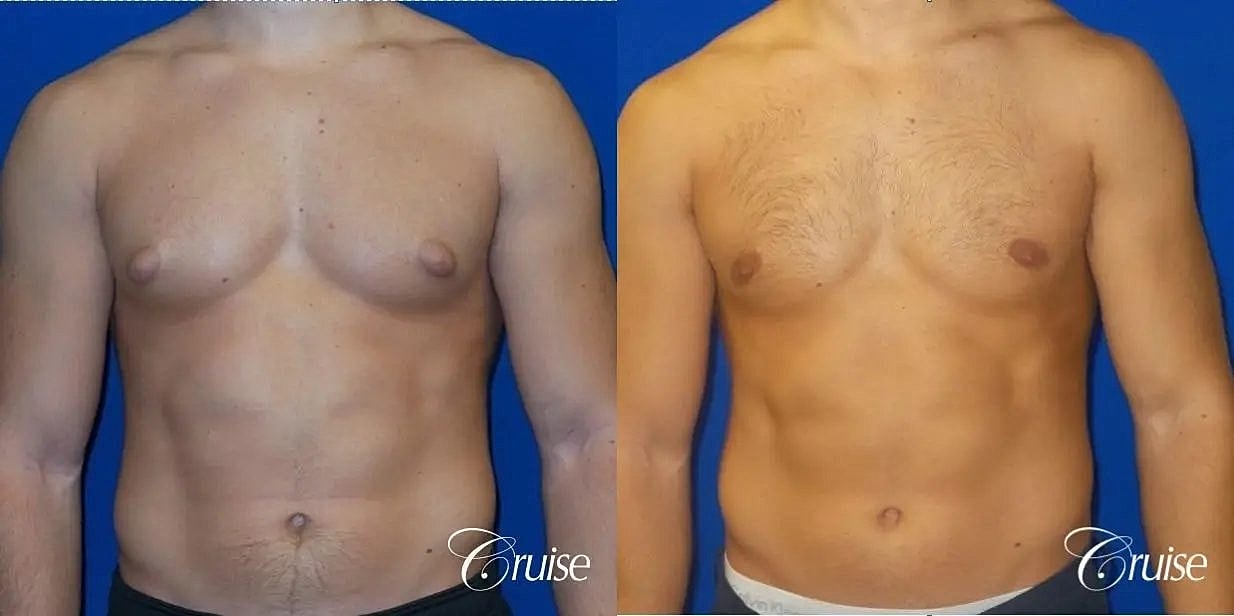 Gynecomastia Before & After