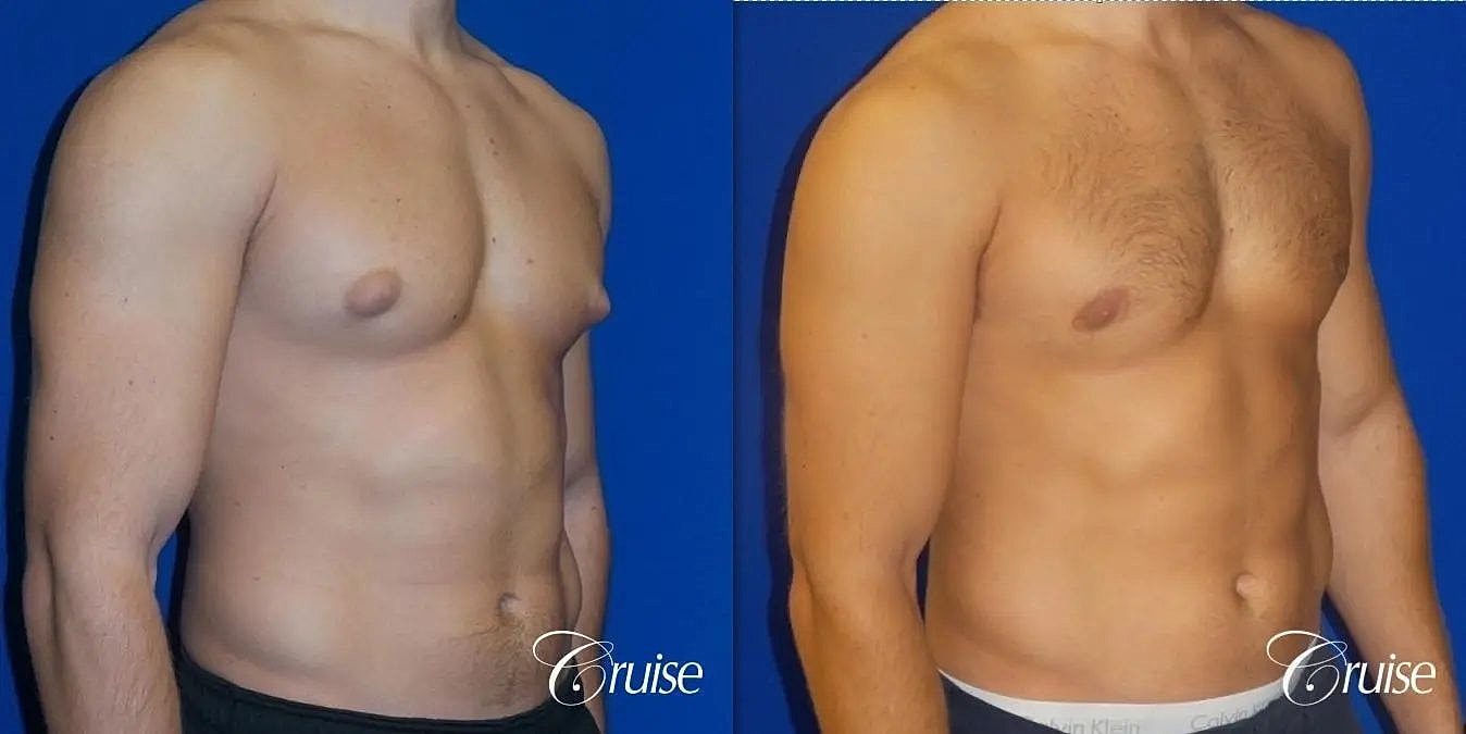 Gynecomastia Before & After