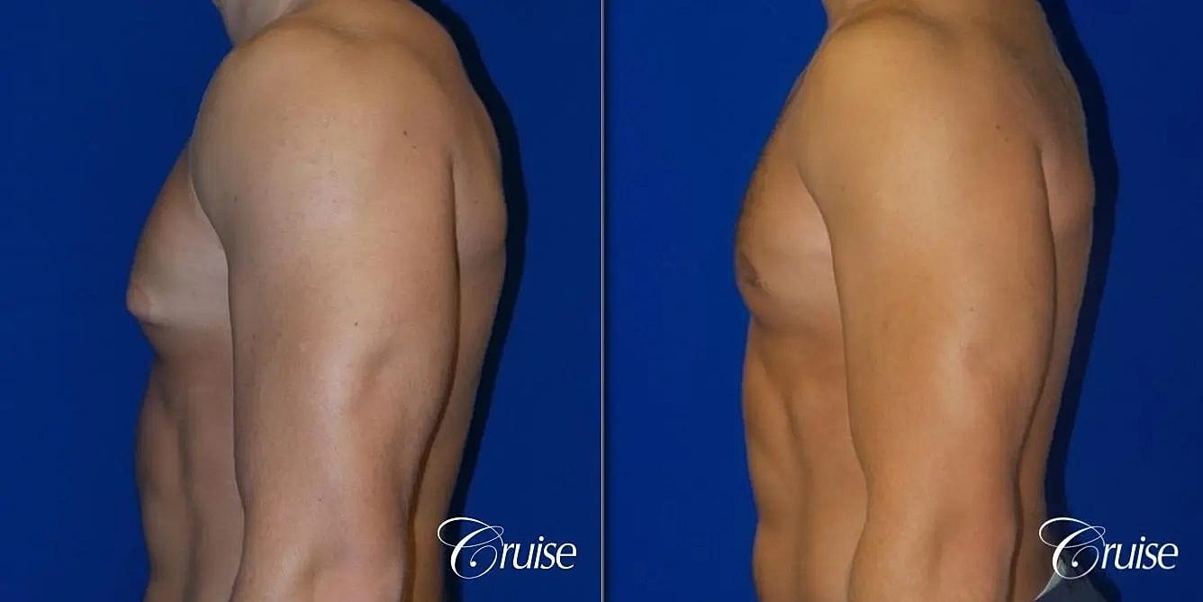 Gynecomastia Before & After