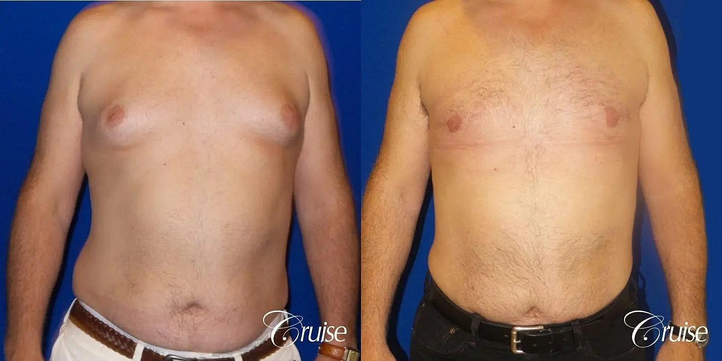 Gynecomastia Before & After
