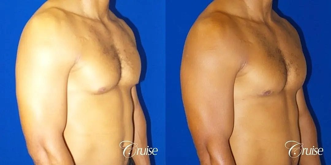 Gynecomastia Before & After