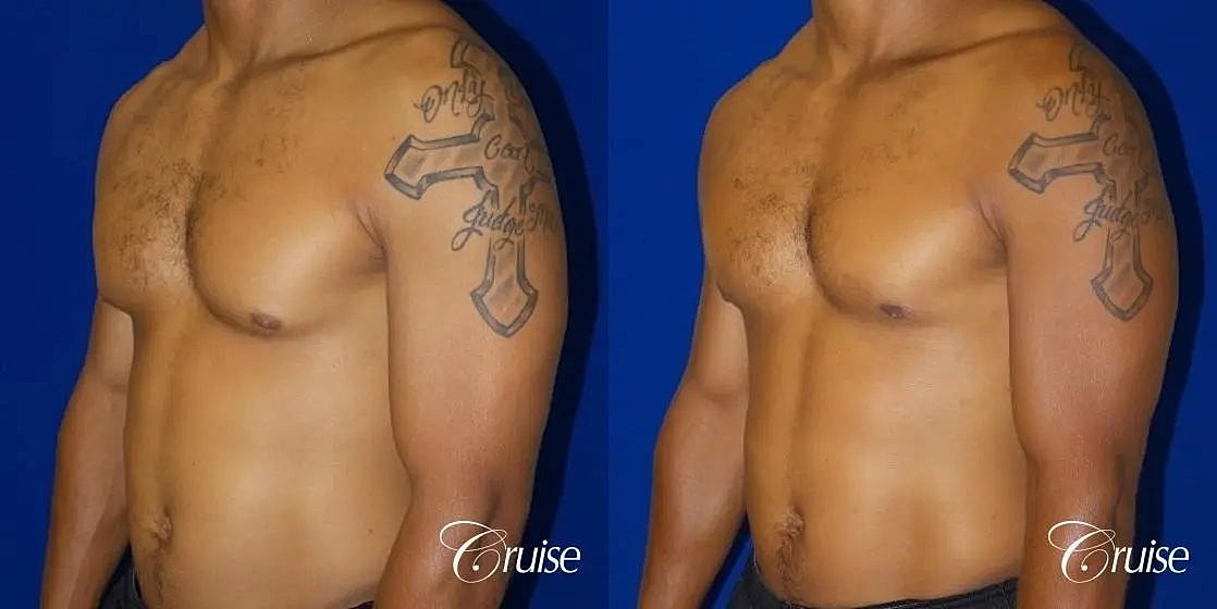 Gynecomastia Before & After