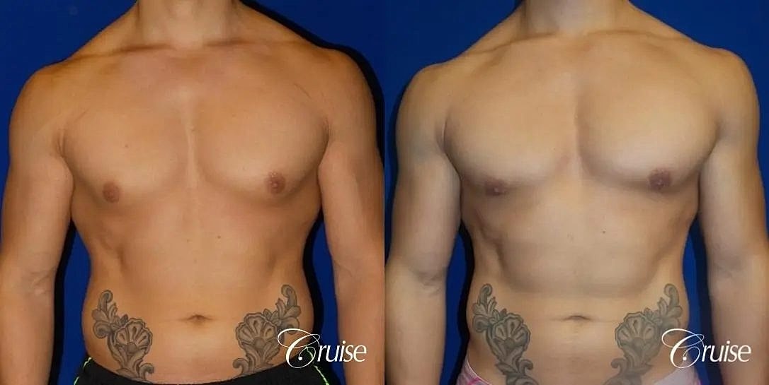 Gynecomastia Before & After