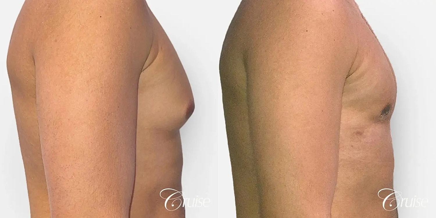 Gynecomastia Before & After