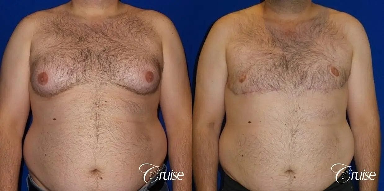 Gynecomastia Before & After